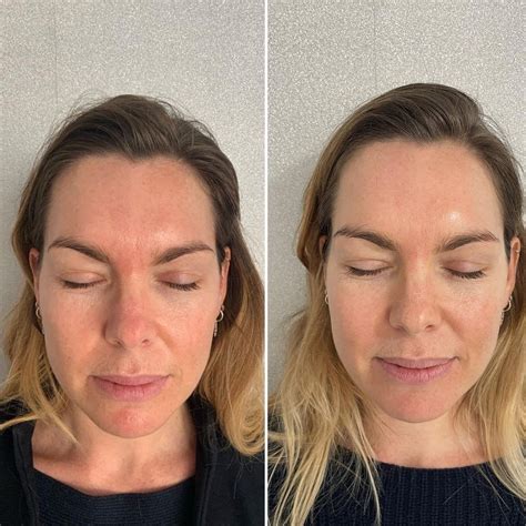 chanel injection review|nctf 135ha before and after.